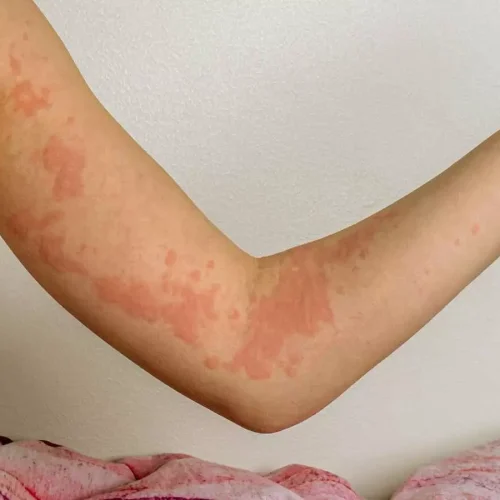 Chronic hives: Researchers identify most effective, safest treatments