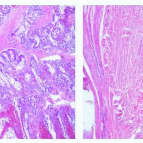 Rare Case Links Peutz-Jeghers Syndrome to Kidney Anomaly, Suggests Broader Screening and STK11 Role