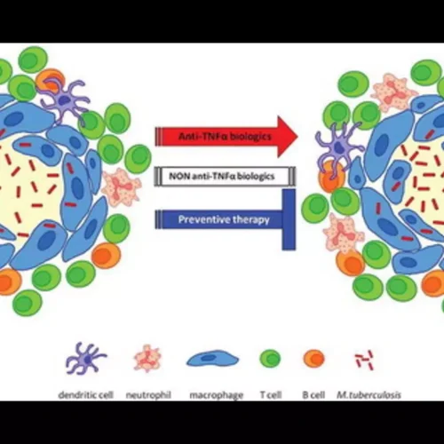 Increased TB Risk in Psoriasis Patients on Etanercept Despite Isoniazid Prophylaxis: Study