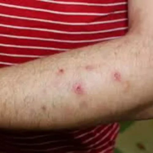 Dupilumab Shows High Efficacy and Safety in Treating Moderate to Severe Prurigo Nodularis: Study