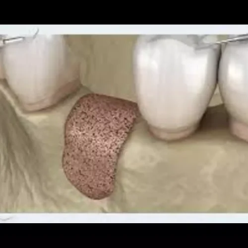 Add on Collagen Membranes over titanium meshes not necessary in GBR-Based VRA: Study