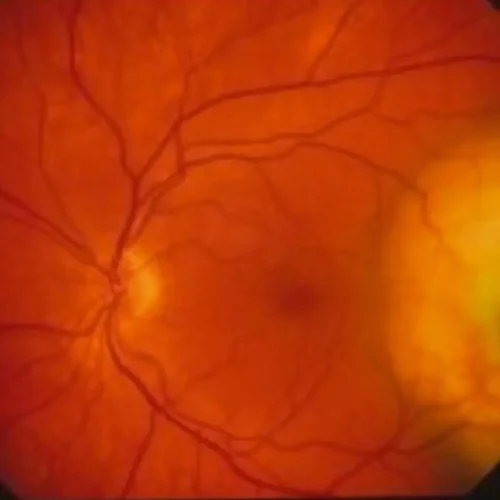 Patients with floaters or flashes could face higher risk of retinal detachment,  reveals research