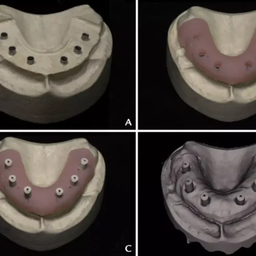 Longer Edentulous Spans Reduce Scanner Accuracy in Full-Arch Digital Workflows: Study