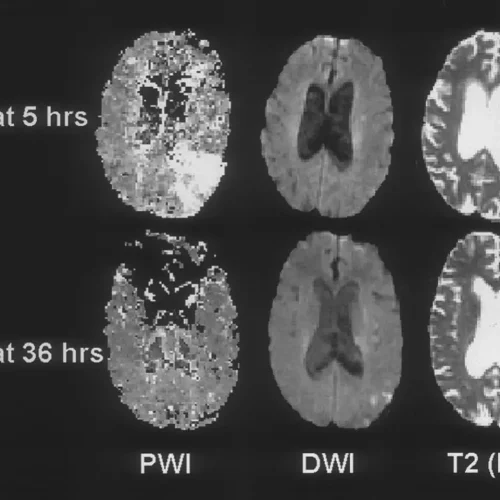 Alteplase May Improve Outcomes When Given 4.5–24 Hours After Stroke in Select Patients: JAMA