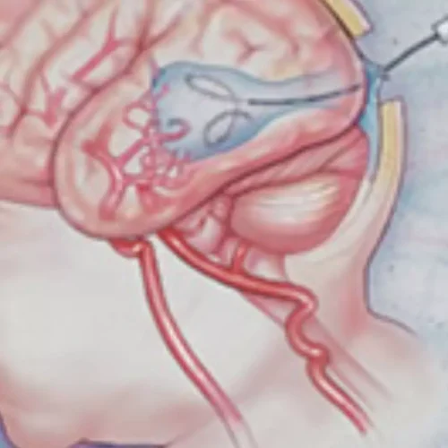 Fetal Embolization Exhibits Early Success in High-Risk Vein of Galen Malformation: JAMA
