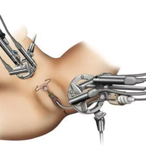 Uterine Manipulators  may Enhance Laparoscopic Rectal Surgery in Women: Study