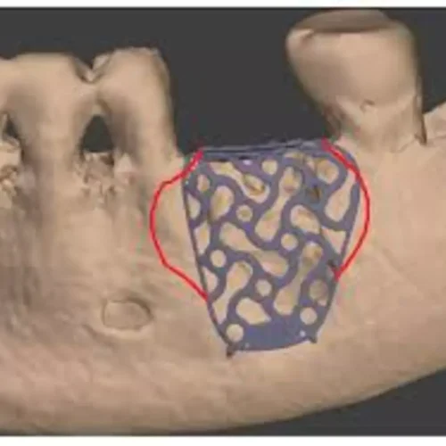 0.3 mm thick Titanium Mesh Found Most Reliable for Guided Bone Regeneration, suggests study