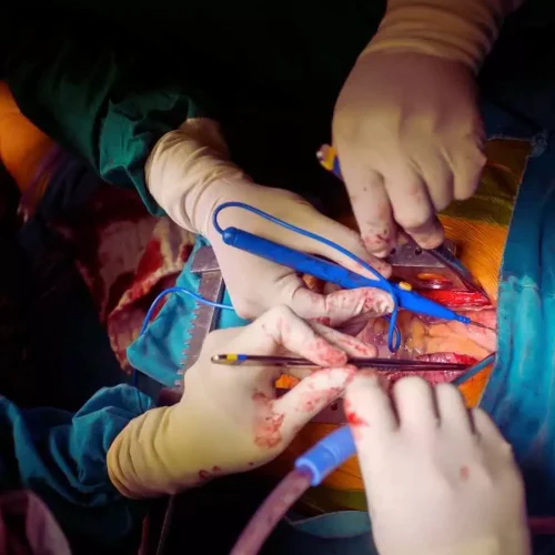 Dual antiplatelet therapy not more effective than aspirin alone after CABG: Study