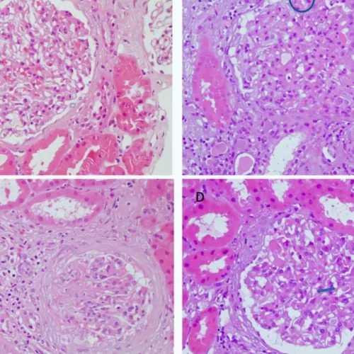 Rare Dual Diagnosis: Alport Syndrome and Immune Complex-Mediated MPGN Coexist in the Same Patient