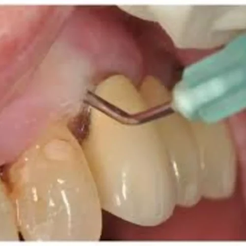 Ozonated Water Shows Modest Benefits in Periodontal Therapy: Study