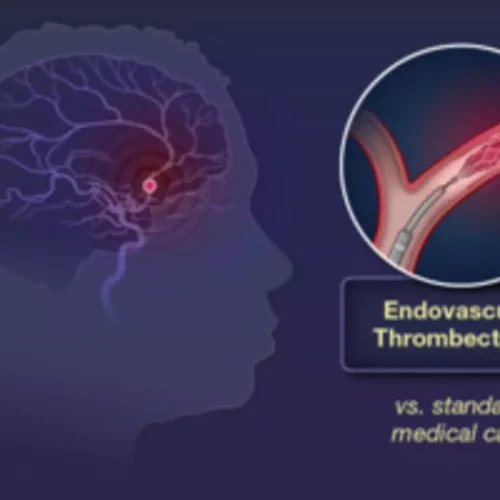 Patients undergoing endovascular Thrombectomy for Large Vessel Occlusion Stroke under GA had improved outcomes: JAMA