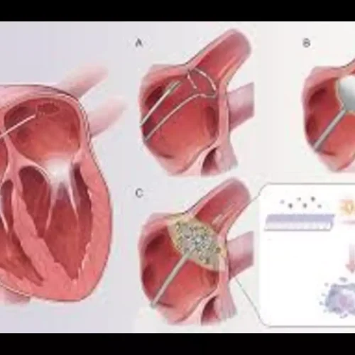 First-in-Human Study Shows Promise for High-Voltage PFA in Treating Scar-Related ventricular tachycardia: Study