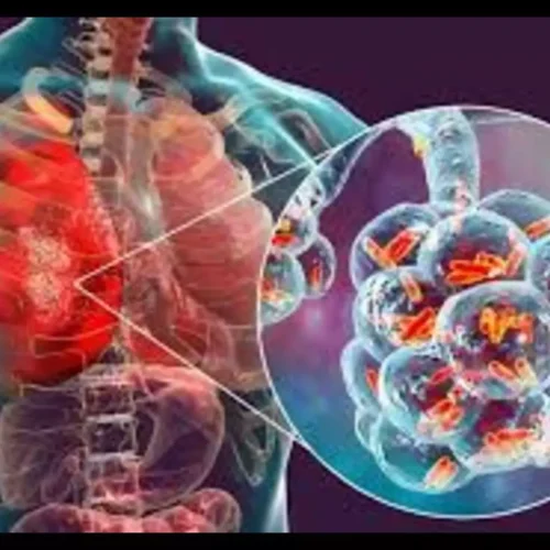 Metabolic Syndrome Tied to Higher 90-Day Mortality in Older Adults with Pneumonia: Study