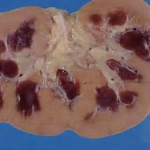 Acute Kidney Injury in CCU Patients Increases Mortality and Hospital Stay: Study