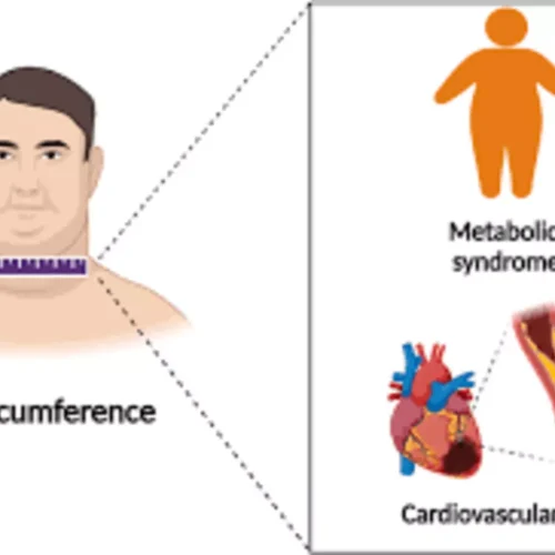 Neck Circumference a Practical Screening Tool for Metabolic Syndrome, suggests Study