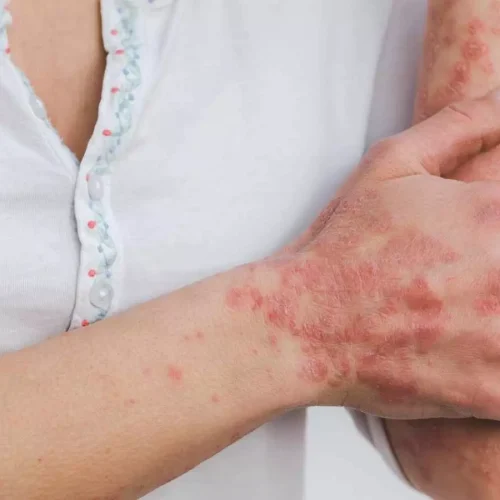 Psoriasis-linked gene mutation also impacts gut health: Study
