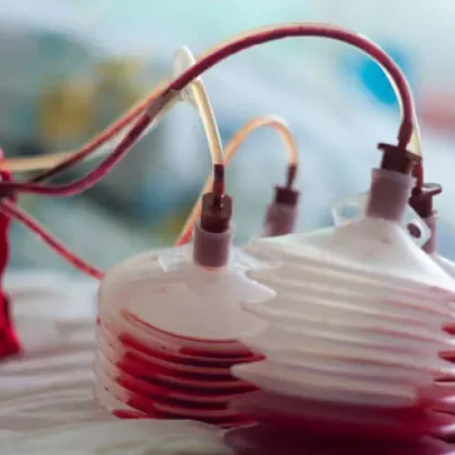 Oral TXA as effective and safe as IV TXA in hip and knee arthroplasty: study