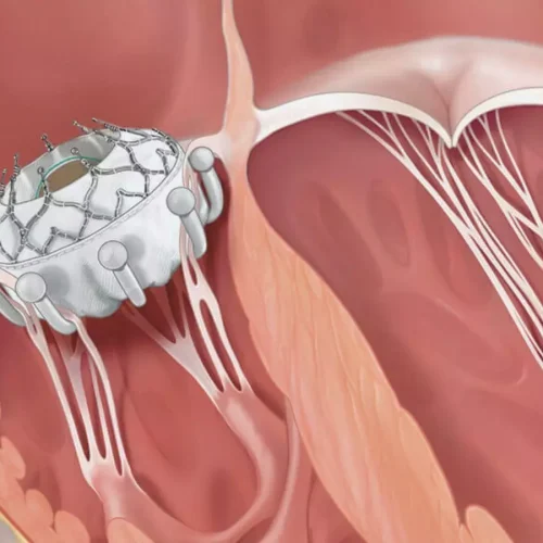 EVOQUE TTVR Delivers Promising Real-World Results: Over 97 Percent Achieve TR Elimination