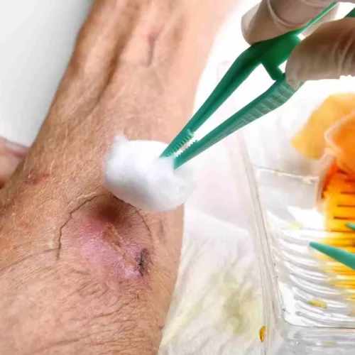 Smart hydrogel mimics skin repair to accelerate diabetic wound healing, suggests research