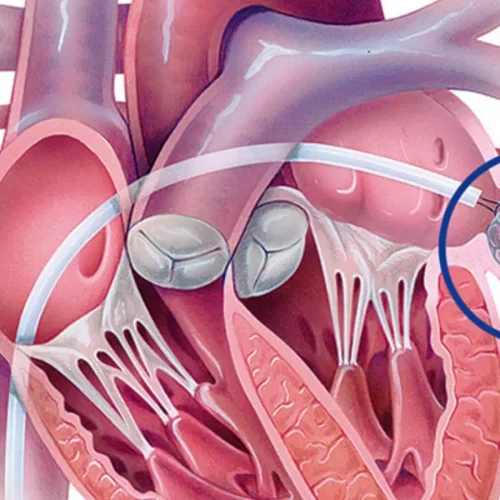 Left Atrial Appendage Closure Not Noninferior to Medical Therapy in High-Risk Atrial Fibrillation: Study
