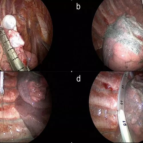 IPLD Useful Adjunct to thoracoscopic bullectomy with pleurodesis for 
Preventing Pneumothorax Recurrence: Study