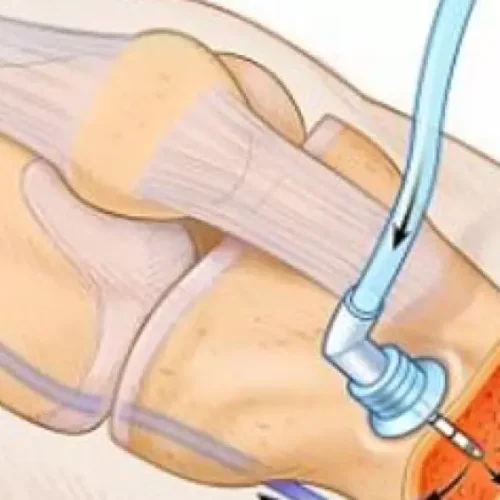 Intraosseous cefuroxime achieved higher local tissue concentrations than IV injection in TKA: study