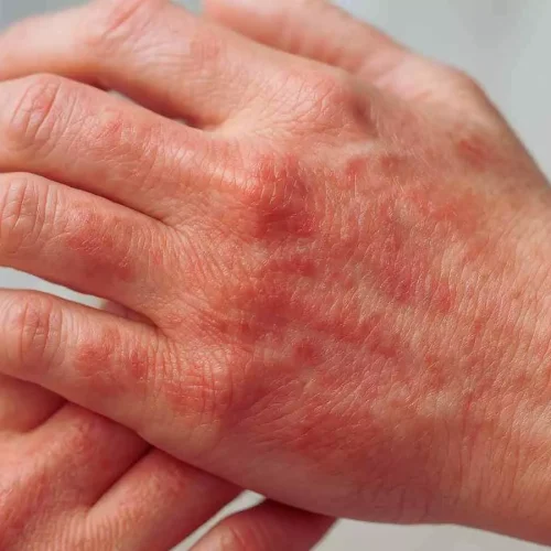 Tralokinumab Shows Sustained Efficacy in Hand Atopic Dermatitis: Study