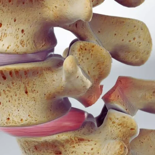 Steeper Pars Angle Strongly Linked to Spondylolysis Risk, New Study Shows