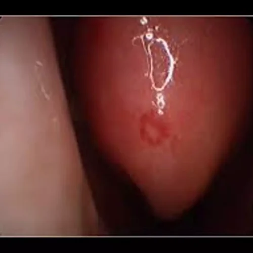 Engasertib Shows Favorable Safety Profile and Reduces Epistaxis in hereditary hemorrhagic telegenctasia: Study