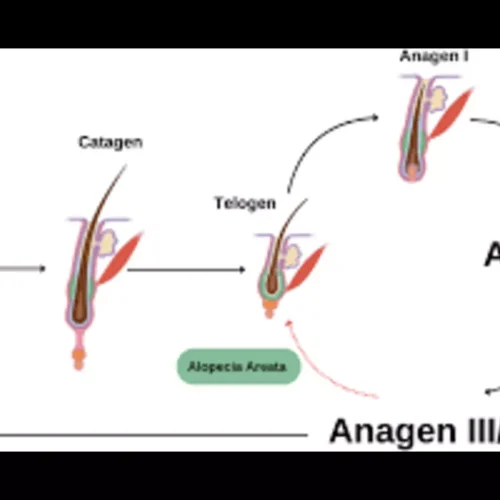 Blood Metabolites May Have Causal Links with Alopecia Areata: Study
