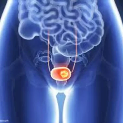 Early Bedside removal of Ureteral Stent feasible and safe during kidney transplantation: Study