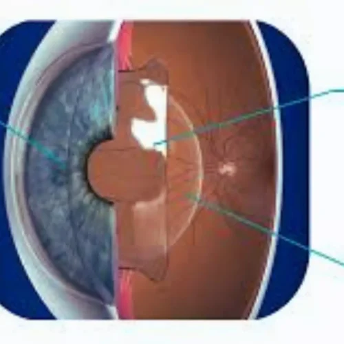 Vertical ICL Fixation Delivers Safer, More Predictable Vault Outcomes: Study Finds