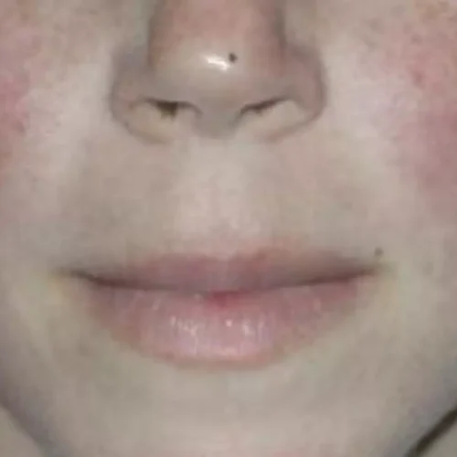 Telitacicept Matches Belimumab in Controlling Childhood Lupus, Study Finds