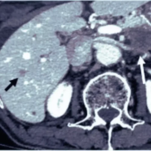 Deep Learning Boosts Image Quality in Low-Dose CT Portal Venography: Study Shows