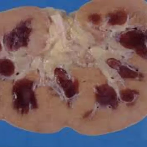 Serum Creatinine Trajectories Predict Short-Term Mortality in AKI on CKD: Study