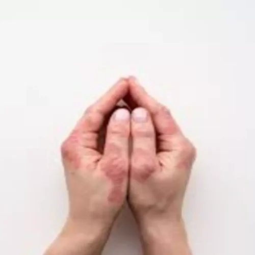 Deucravacitinib Shows Durable Efficacy in Psoriasis Over 2 Years, finds study