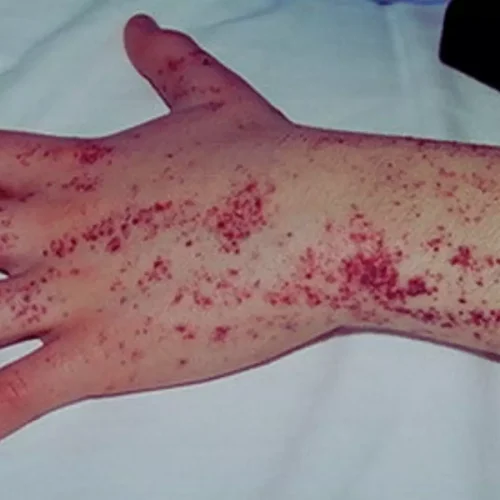 Lucerastat Shows Exploratory Renal Signals in Fabry Disease: Study