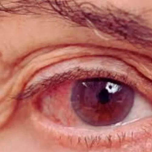 Study Finds Modest but Significant Alzheimer’s Risk in Patients With Glaucoma