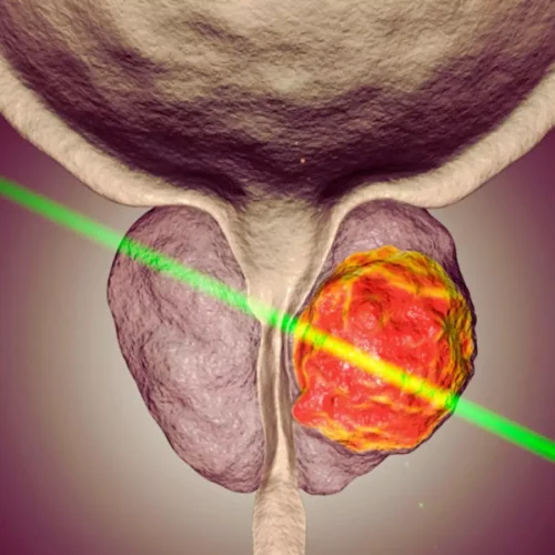 Focal Laser Ablation Offers Oncological and Functional Control Compared to Other Focal Therapies: Study