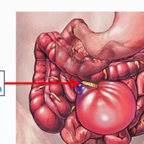 Laparoscopy Offers No Long-Term Edge Over Open Surgery in Small Bowel Obstruction: LASSO Trial