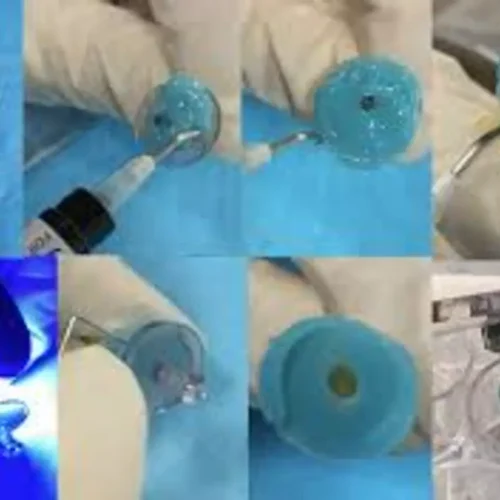 GentleWave technology Shows Promising Antibacterial Efficacy in Root Canal Therapy: Study