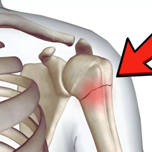 Study Finds Intramedullary Nailing Superior to Dual Plating in Selected Shoulder Fractures