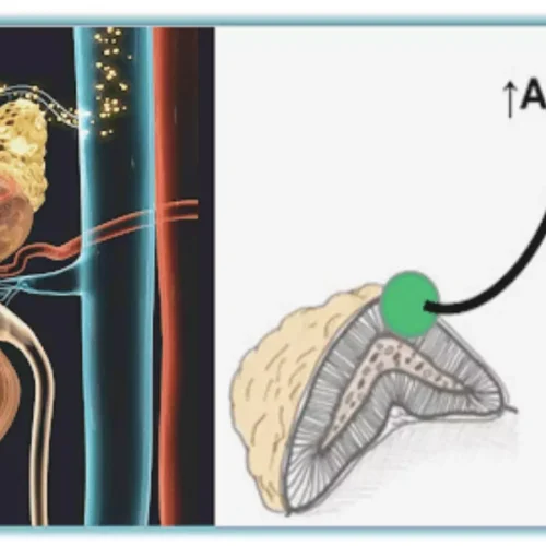 Higher Aldosterone-Renin Ratio Linked to AF and Stroke Risk in Older Adults: ARIC Study