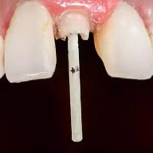 CAD/CAM Glass Fiber Posts Improve Fracture Strength and Safety of canine roots: Study