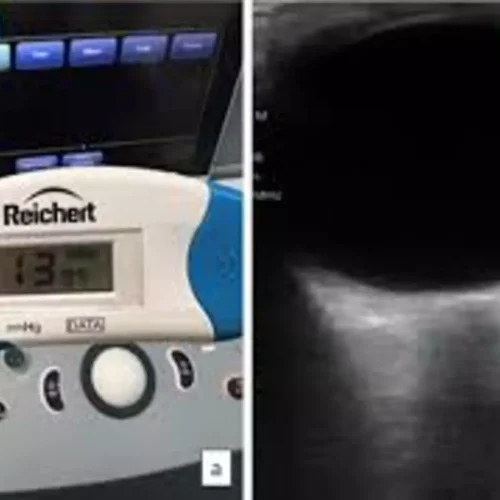 Tonsillar Retractor Use Raises ICP and IOP During Adenotonsillectomy: Study