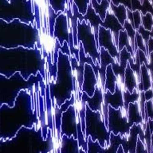 EEG-Based Brain Age Index promising Predictor of Dementia Risk: JAMA