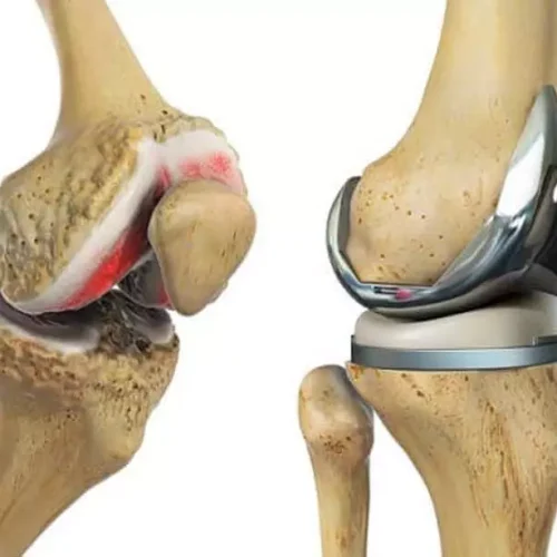 Cruciate-Retaining implants do not provide more natural joint feeling than Cruciate-Substituting implants in TKA: study