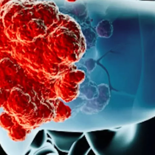 Percutaneous thermal ablation exhbits 
near-Zero Mortality, 3 Percent Complication Rate in small malignant liver tumors: Meta-Analysis