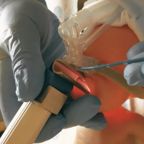 Early Caffeine Plus Less Invasive Surfactant Administration Fails to Benefit in Death or NDI in Preterm Infants on CPAP: JAMA